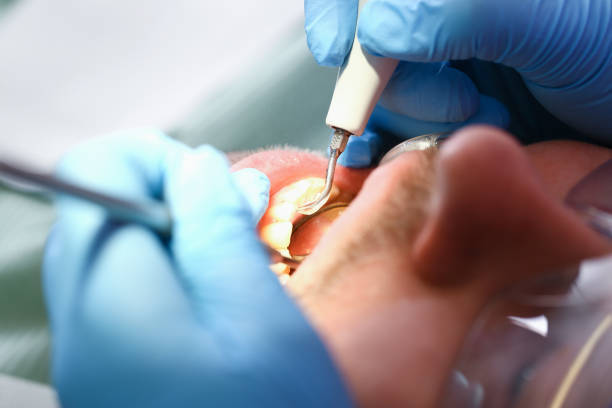 Best Broken or Chipped Tooth Repair in Belleair Bluffs, FL